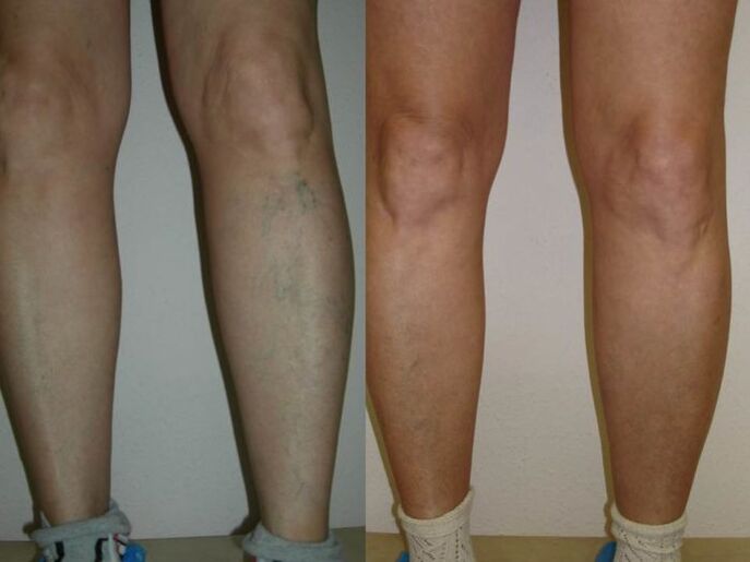 noge prije i poslije laserskog tretmana proširenih vena