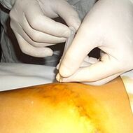 Miniflebektomija je najkozmetičkiji tretman za proširene vene
