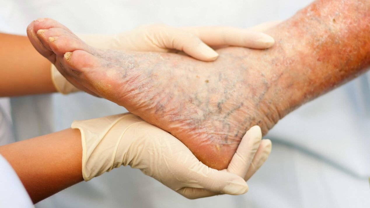 Flebolog se bavi liječenjem proširenih vena na nogama